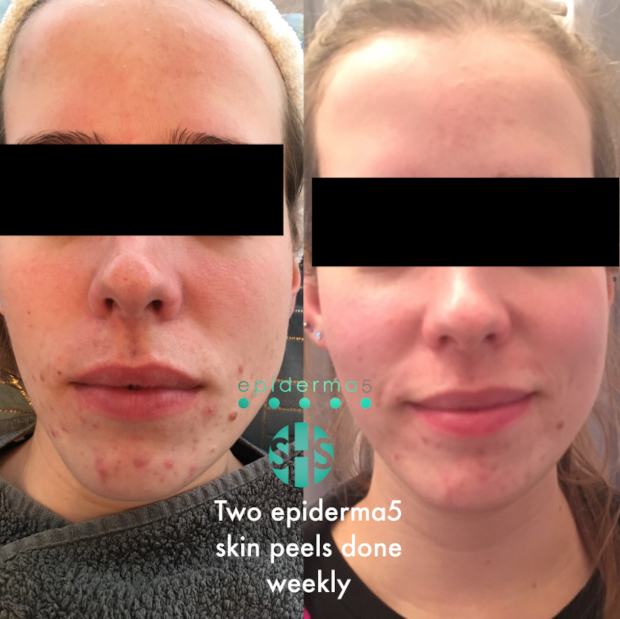 skin-peel-1.jpg