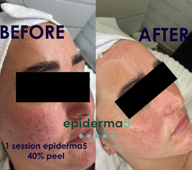 skin-peel-3.jpg