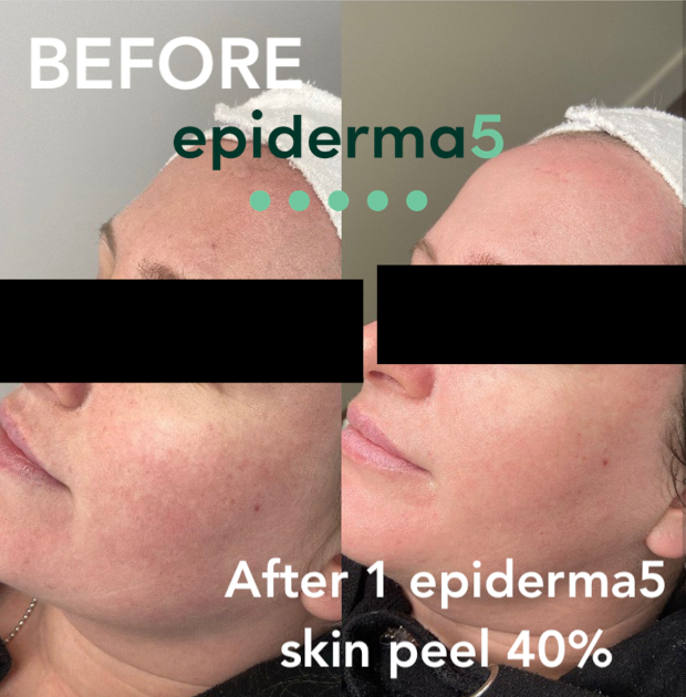 skin-peel-4.jpg